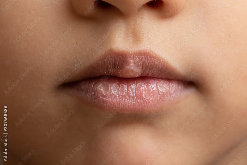 Chapped lips of a little girl, the cold winter climate has caused dry lips with cracks Stock