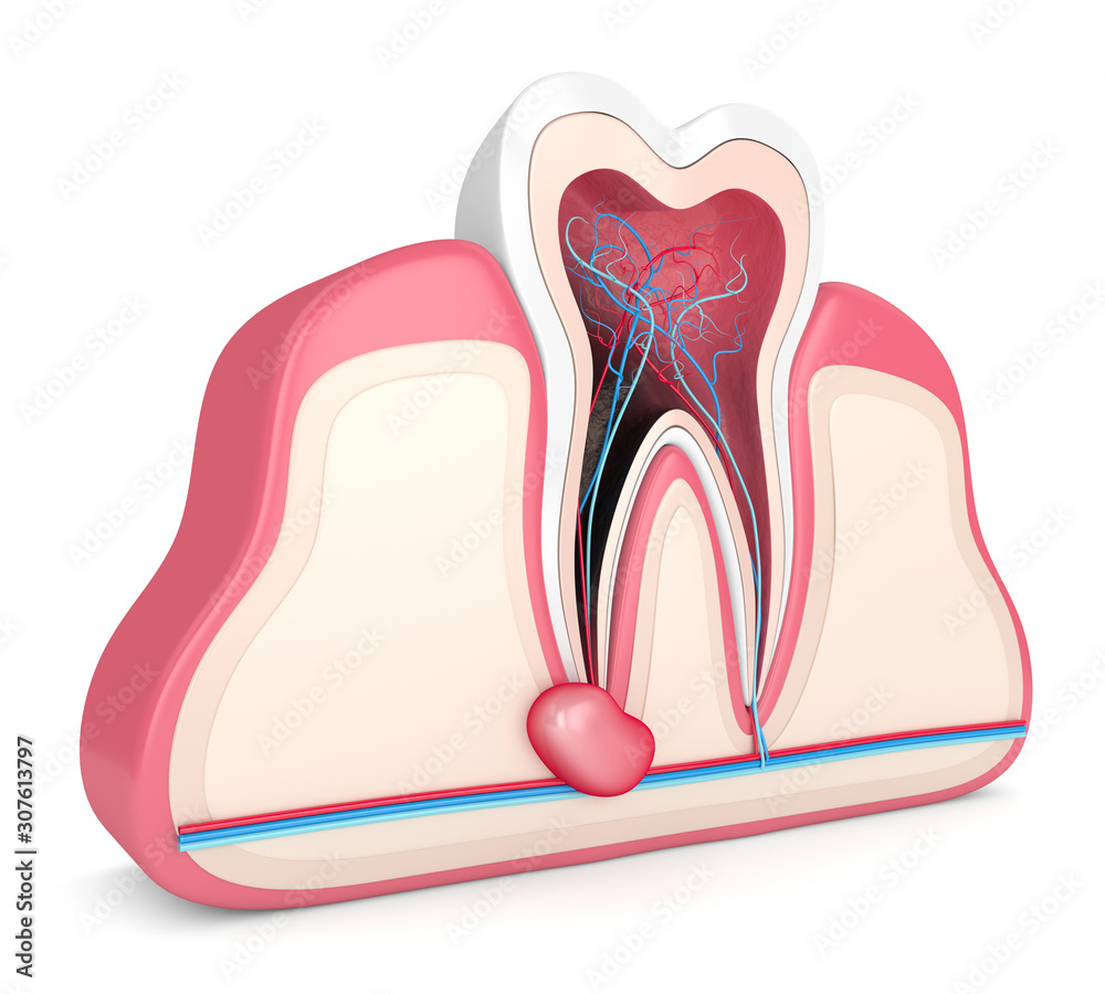 3d render of tooth in gums with cyst 3d render of tooth in gums with cyst