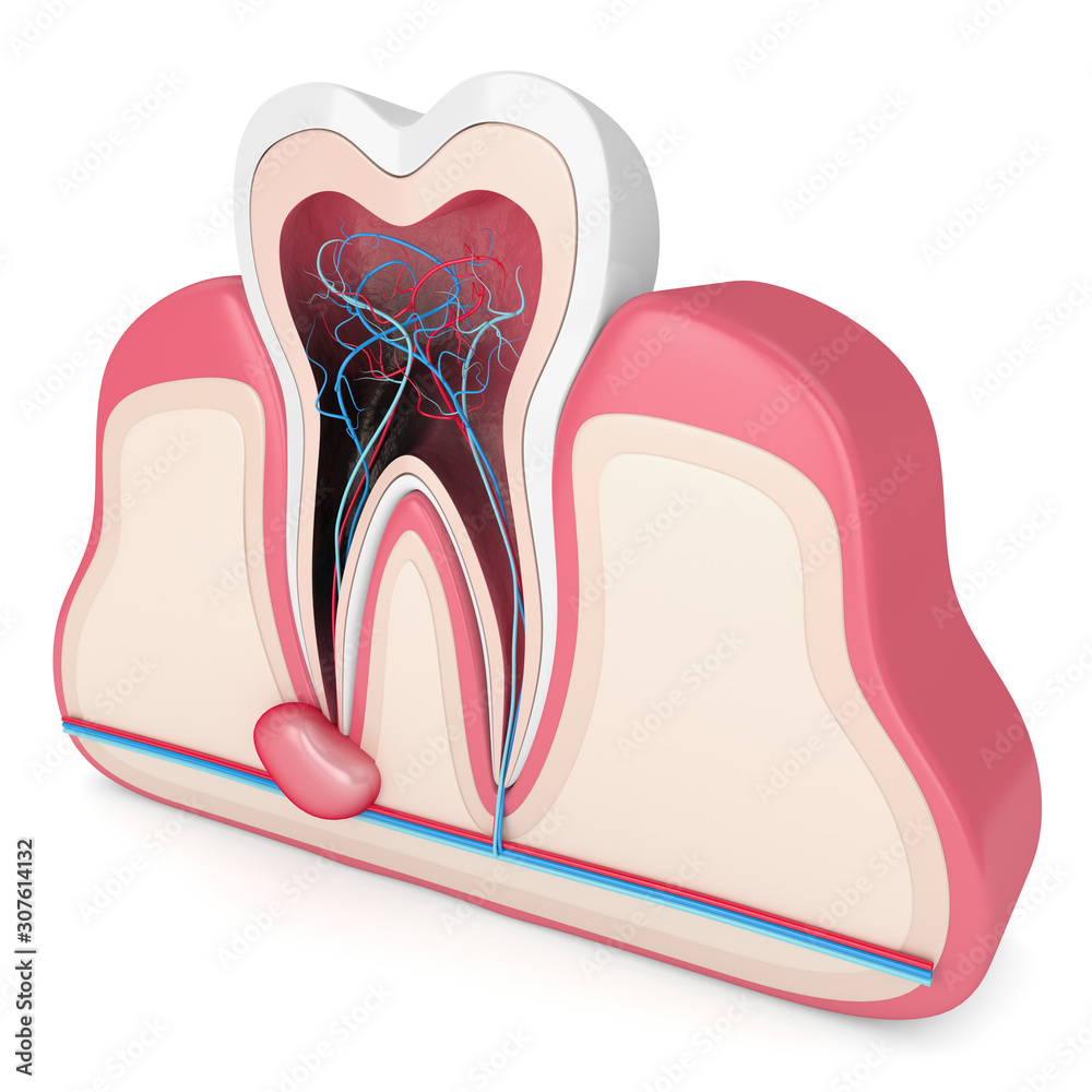 3d render of tooth in gums with cyst 3d render of tooth in gums with cyst