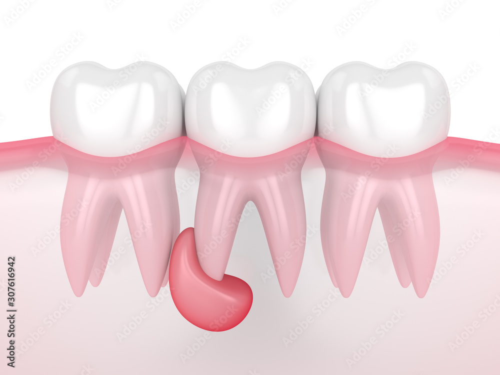 3d render of teeth in gums with cyst 3d render of teeth in gums with cyst