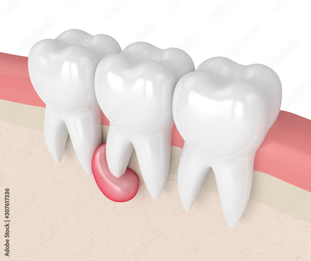3d render of teeth in gums with cyst 3d render of teeth in gums with cyst