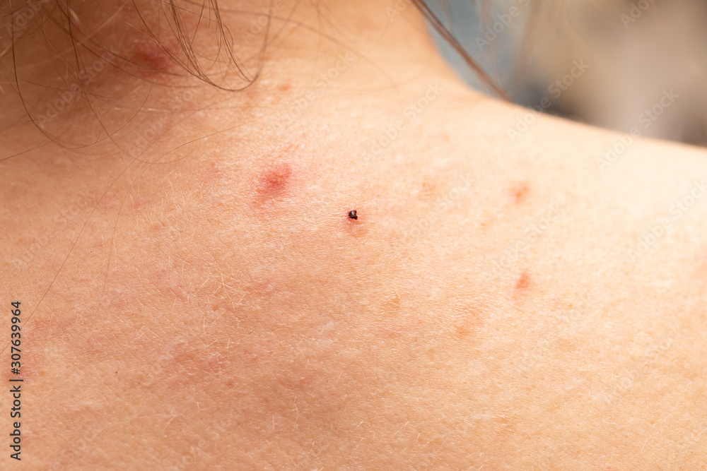 seen from the shoulders with acne skin, concept of skin disorder seen from the shoulders with acne skin, concept of skin disorder