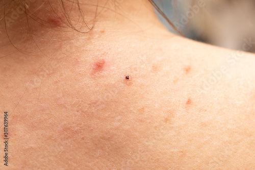 seen from the shoulders with acne skin  concept of skin disorder