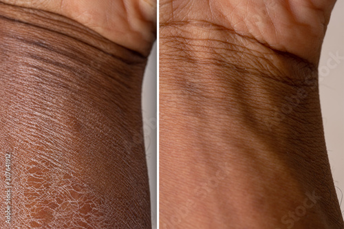 Fotótapéta dry skin before and after treatment: therapy concept for dry and dehydrated skin