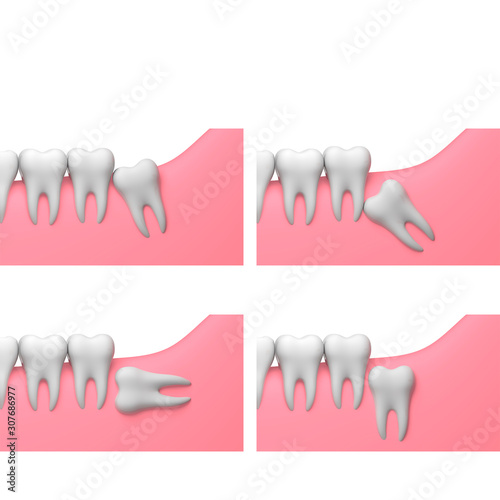 Types of wisdom tooth impactions, white background, collage, 3D-render illustration