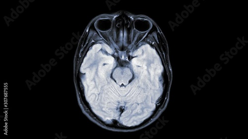 MRI of the brain  axial t2 flair  for detect brain stroke disease.