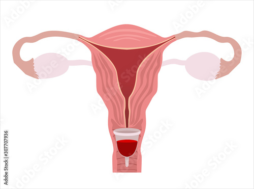 Menstrual cup - feminine hygiene product, device for collecting blood during menstruation and period is used inside the vagina of woman female