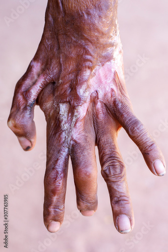 The hand of an accidentally disabled person,Hand scar, wrinkled skin, dirty hands