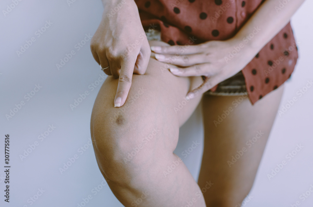 Naklejka premium Bruise on woman leg skin,Healthy skin body care concept,Copy space for text on white background