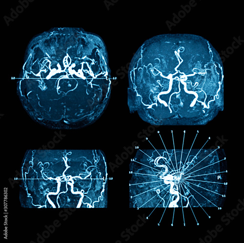 Magnetic resonance imaging (MRI) of brain, case of intracerebral hemorrhages photo