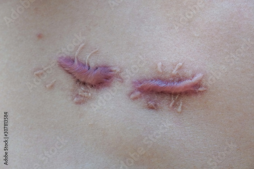 Closeup of Keloid scars by surgery, injury, damaged body, treatment.