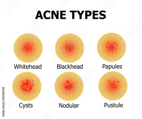 Types of acne on the face