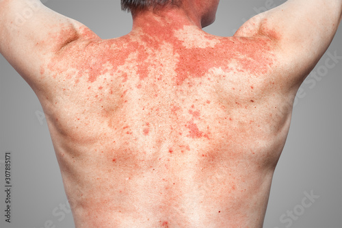 Skin allergy to the human body, Peanut Allergy