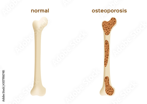 osteoporosis bone graphic vector / low density human calcium / anatomy