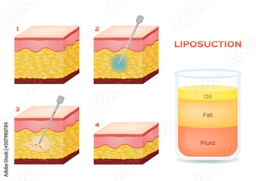 Liposuction before and after , fat , diet , surgery vector