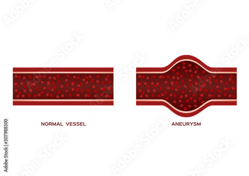 aneurysm blood vessel / anatomy vector