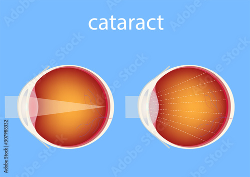 cataract; eye; lens; diagram; structure; ball; disease; diagnosis; clouding; care; blurr; organ; anatomy; medical; care; human; body; blind; vision; normal; section; vector; graphic; science; educatio