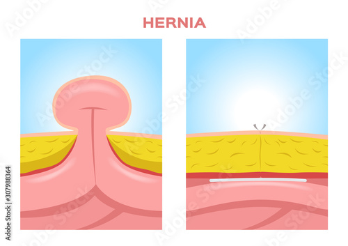 umbilical hernia vector in white background / intestine photo