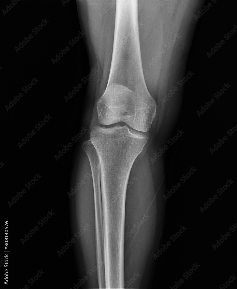 normal radiography of the knee joint in the frontal projection medical diagnostics, Traumatology and orthopedics normal radiography of the knee joint in the frontal projection medical diagnostics, Traumatology and orthopedics