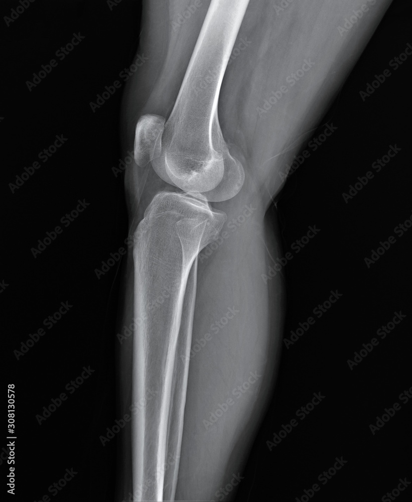 normal radiography of the knee joint in lateral projection, medical diagnostics, traumatology and orthopedics normal radiography of the knee joint in lateral projection, medical diagnostics, traumatology and orthopedics