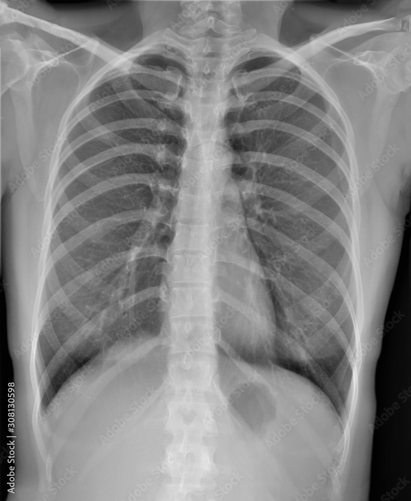 normal radiography of chest organs in direct projection, pulmonology normal radiography of chest organs in direct projection, pulmonology