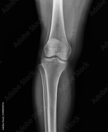 normal radiography of the knee joint in the frontal projection medical diagnostics  Traumatology and orthopedics