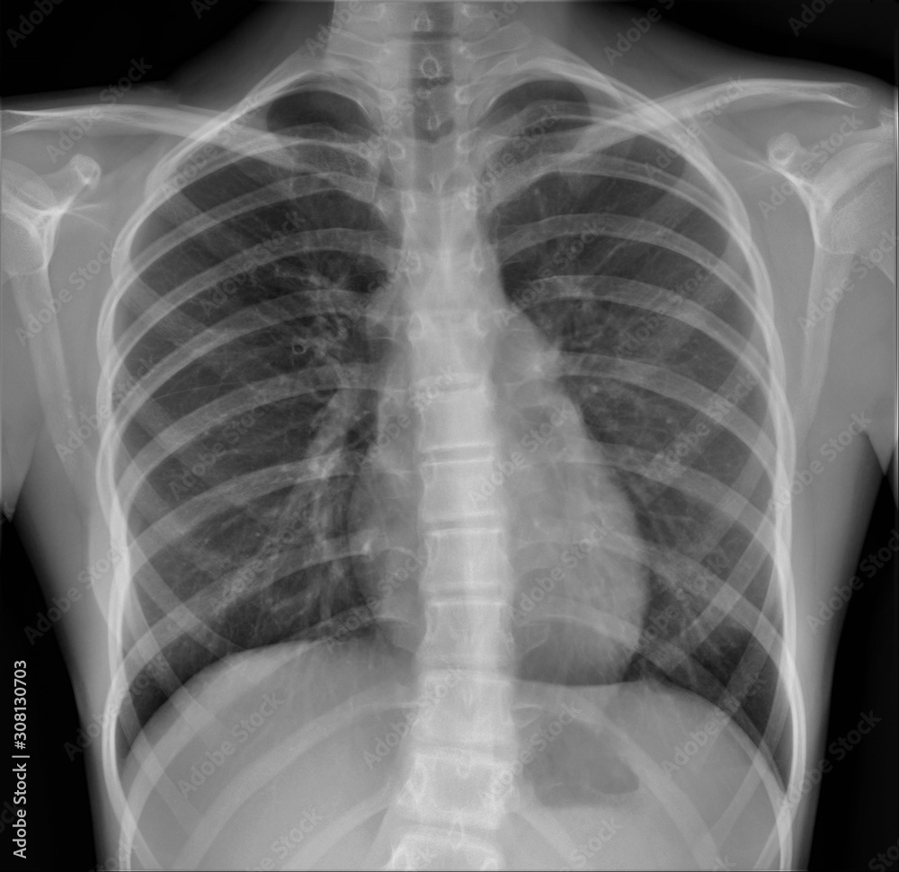 normal radiography of chest organs in direct projection,  pulmonology