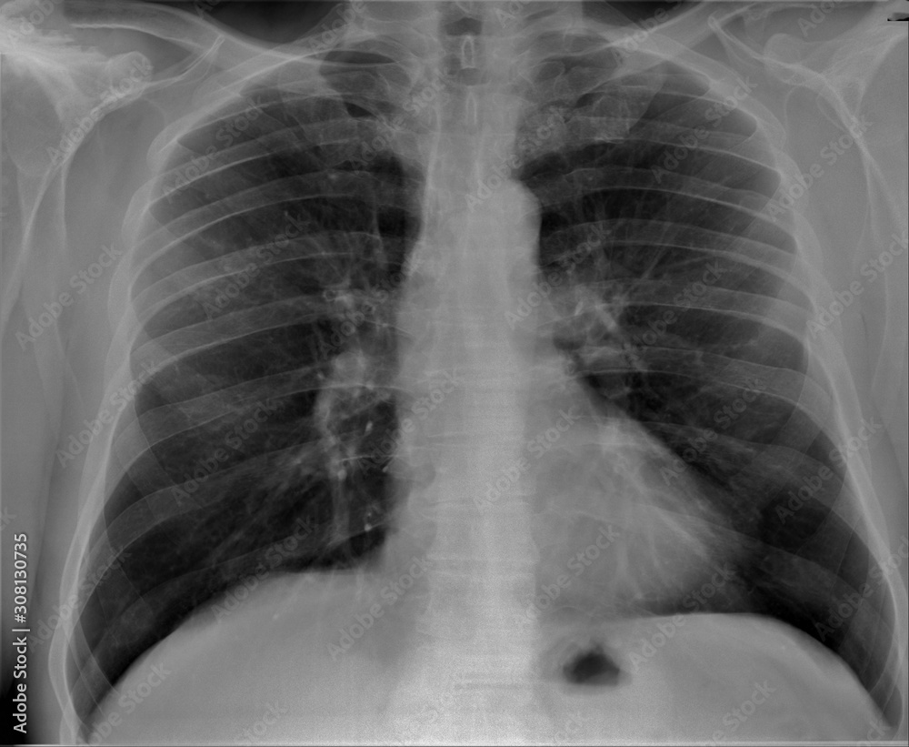 normal radiography of chest organs in direct projection, pulmonology ...