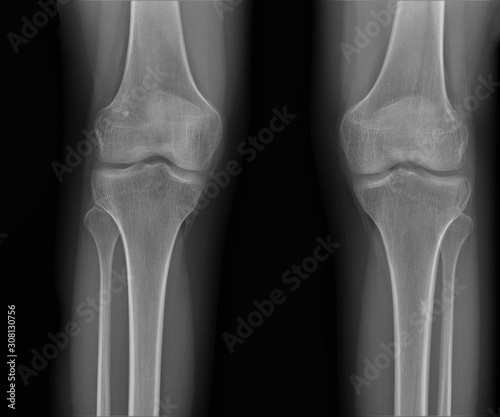 normal radiography of the knee joint in the frontal projection medical diagnostics, Traumatology and orthopedics