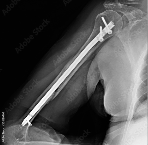 x-ray of a fracture of the humerus ,the osteosynthesis intramedullary. Traumatology and orthopedics, medical diagnostics