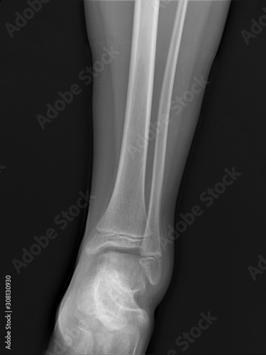 normal radiograph of the ankle joint in front projection osteoarthritis osteoporosis