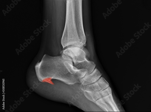 radiograph of the ankle joint in the lateral projection, heel spur.Osteoarthritis, Osteoporosis