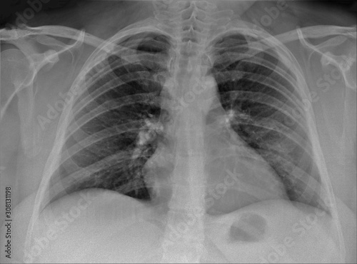 normal radiography of chest organs in direct projection, pulmonology