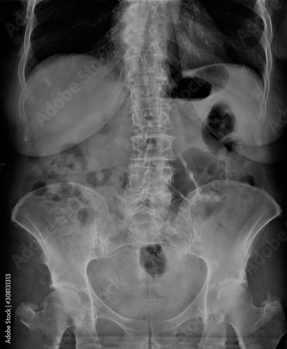 radiography of lumbar and sacral spine, pelvis, coxarthrosis, medical diagnostics