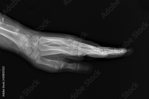 radiography of bones and fingers with arthrosis, orthopedics, medical diagnostics, Rheumatology