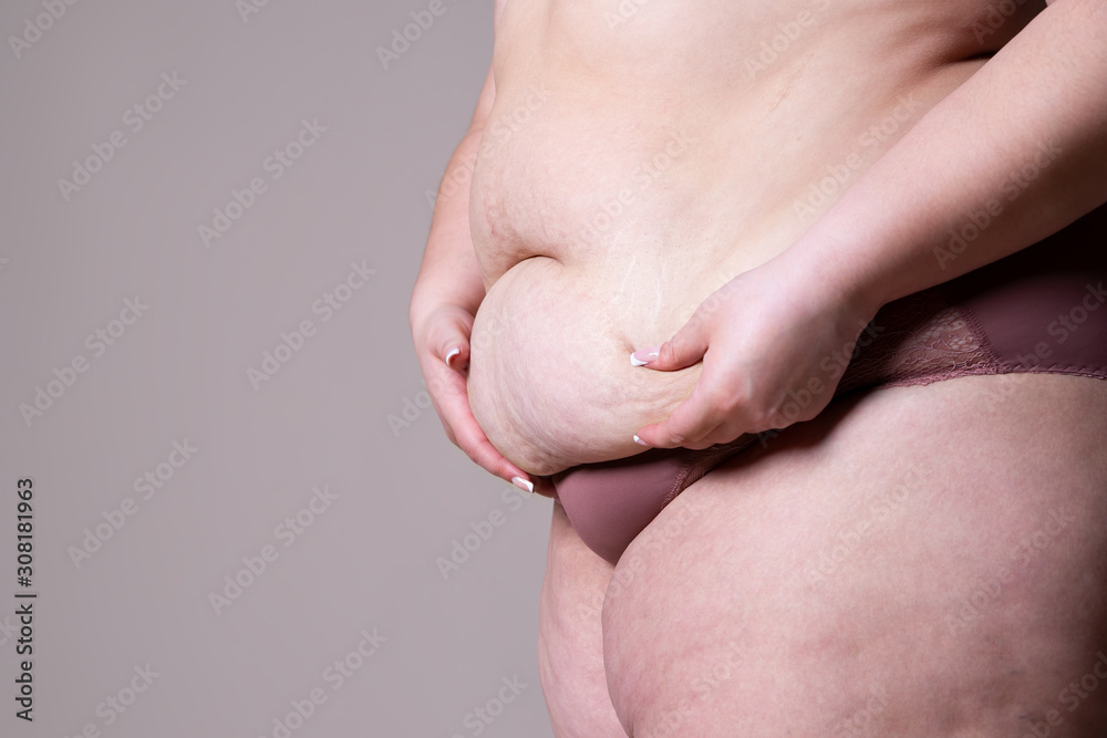 Tummy tuck, flabby skin on a fat belly, plastic surgery concept Tummy tuck, flabby skin on a fat belly, plastic surgery concept