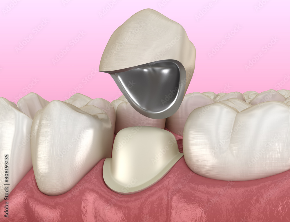 Preparated premolar tooth and dental metalceramic crown. Medically