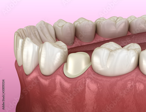 Preparated premolar tooth for dental metal-ceramic crown placement. Medically accurate 3D illustration