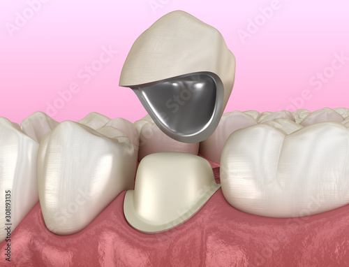 Obraz na płótnie Preparated premolar tooth and dental metal-ceramic crown