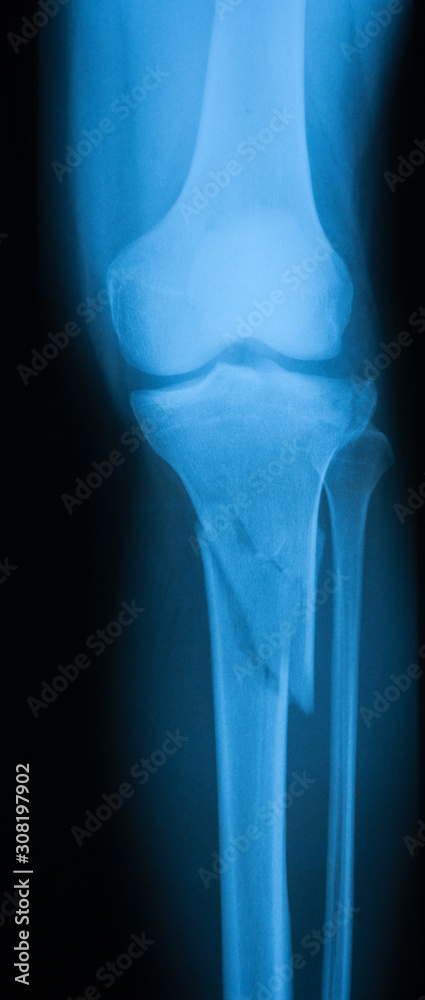 broken femur x ray
