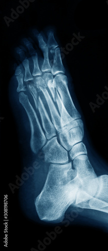 X-ray image of foot showing metatarsal bone fractures, oblique view.