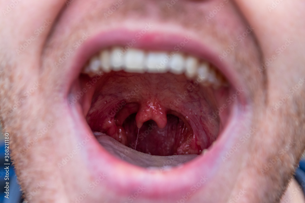 Mutiertes Halszäpfchen und doppelte Uvula oder Staphyle zeigt zweigeteilte Mutation des