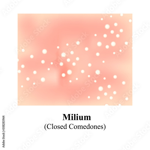 Miliums, closed comedones, Skin with blackheads. Black spots. Acne on the skin. Infographics. Vector illustration.