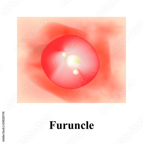 Pustules on the skin. Cystic acne. Pimples on the skin. Furuncle. Infographics. Vector illustration.