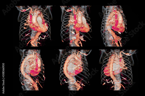 Collection  of CTA thoracic aorta  3D rendering image for  diagnotic abdominal aortic aneurysm or AAA and aortic dissection photo