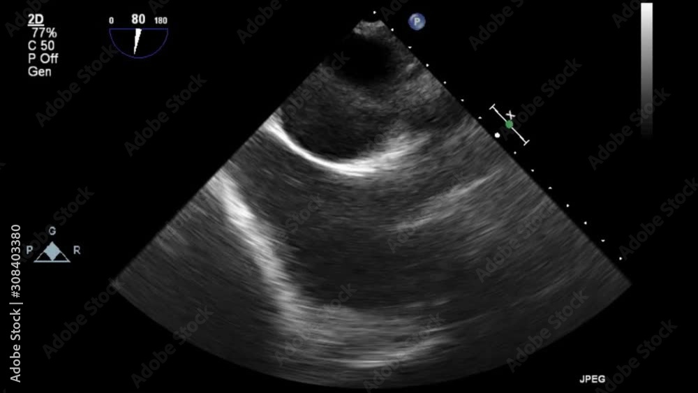 High quality transesophageal ultrasound video in gray-scale mode.