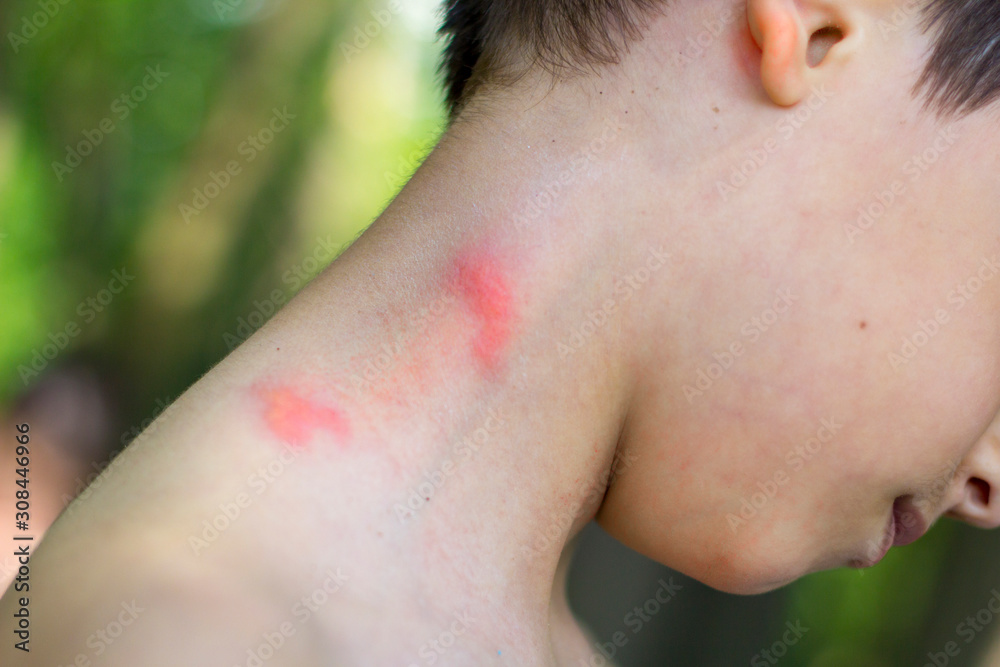 insect bites on a little boy's neck insect bites on a little boy's neck