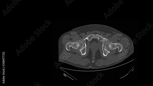 CT scan(computed tomography)hip radiograph show broken hip bone or fracture acetabulum(acetabular fracture disease). Patient has crushing injury. Orthopedic trauma and medical science concept photo