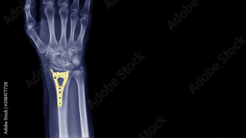 Fotografia, Obraz Film X-ray wrist radiograph show lower end of forearm bone broken (distal end radius fracture) treatment by plate fixation surgery (ORIF operation)