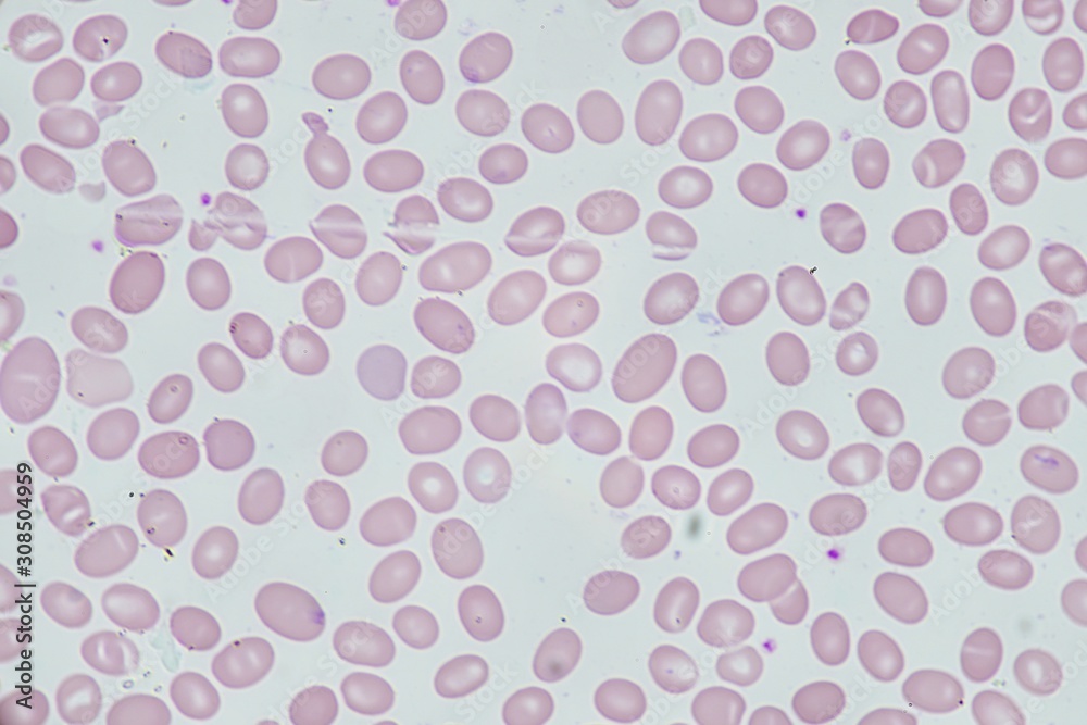 Abnormal red blood cell